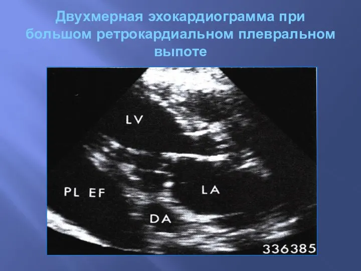 Двухмерная эхокардиограмма при большом ретрокардиальном плевральном выпоте