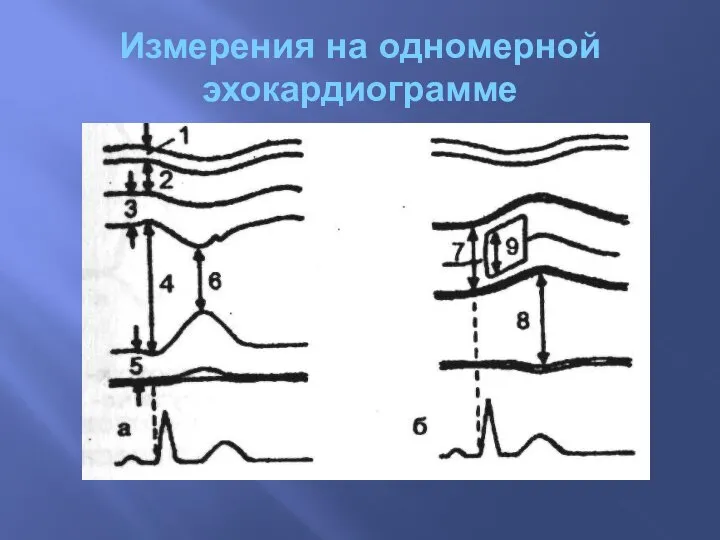 Измерения на одномерной эхокардиограмме