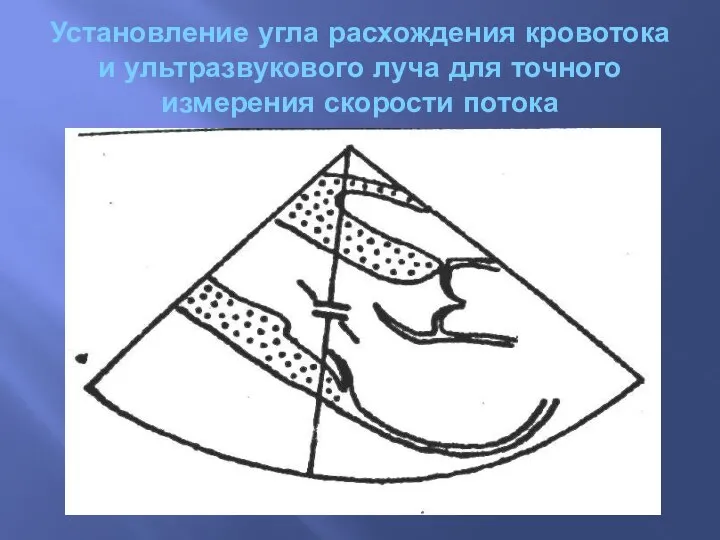 Установление угла расхождения кровотока и ультразвукового луча для точного измерения скорости потока