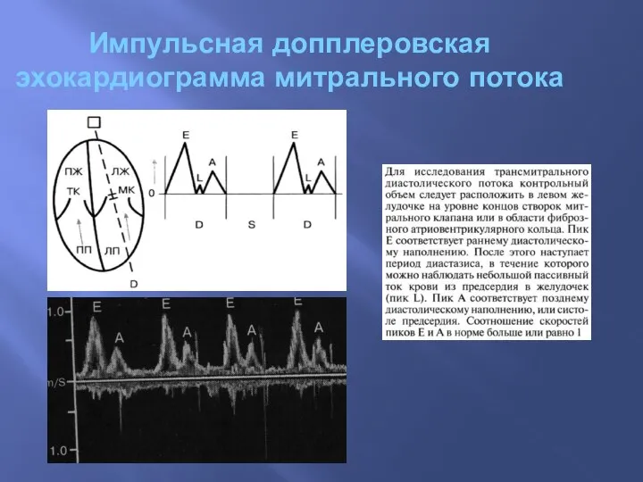 Импульсная допплеровская эхокардиограмма митрального потока