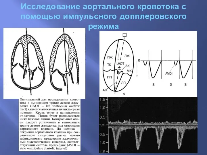 Исследование аортального кровотока с помощью импульсного допплеровского режима