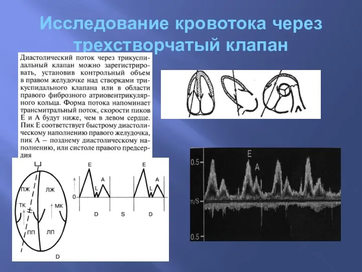 Исследование кровотока через трехстворчатый клапан