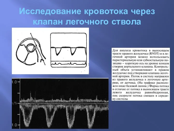 Исследование кровотока через клапан легочного ствола