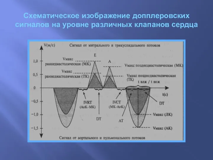 Схематическое изображение допплеровских сигналов на уровне различных клапанов сердца