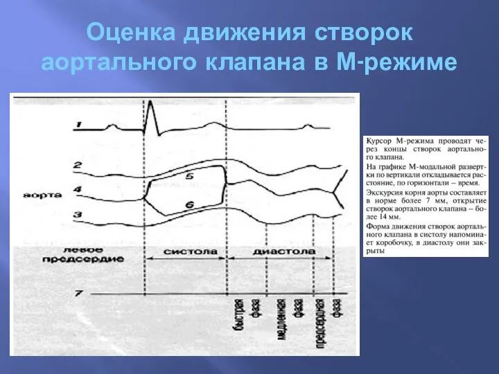 Оценка движения створок аортального клапана в М-режиме