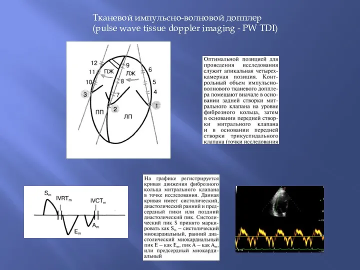 Тканевой импульсно-волновой допплер (pulse wave tissue doppler imaging - PW TDI)