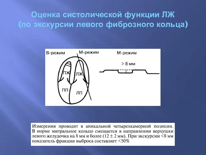 Оценка систолической функции ЛЖ (по экскурсии левого фиброзного кольца)