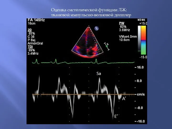 Оценка систолической функции ЛЖ: тканевой импульсно-волновой допплер