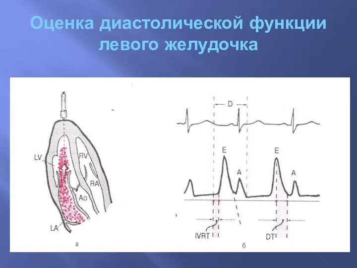 Оценка диастолической функции левого желудочка