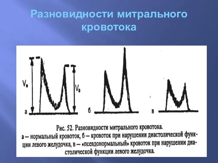 Разновидности митрального кровотока