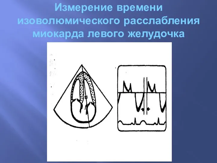 Измерение времени изоволюмического расслабления миокарда левого желудочка