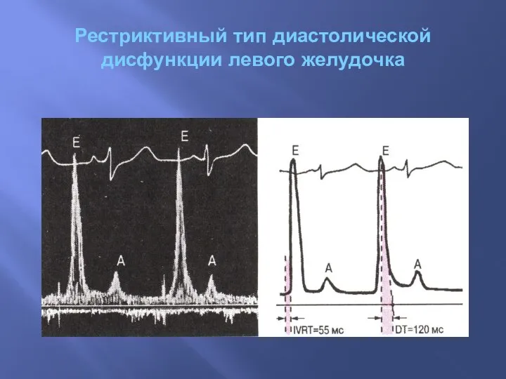Рестриктивный тип диастолической дисфункции левого желудочка