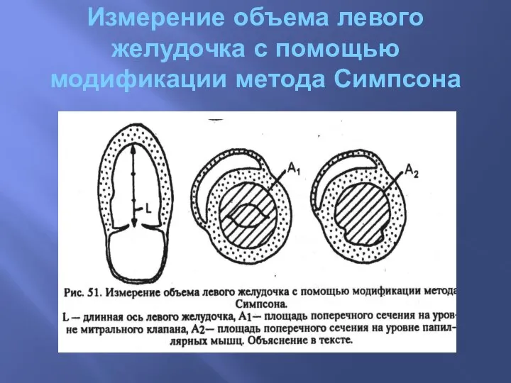 Измерение объема левого желудочка с помощью модификации метода Симпсона