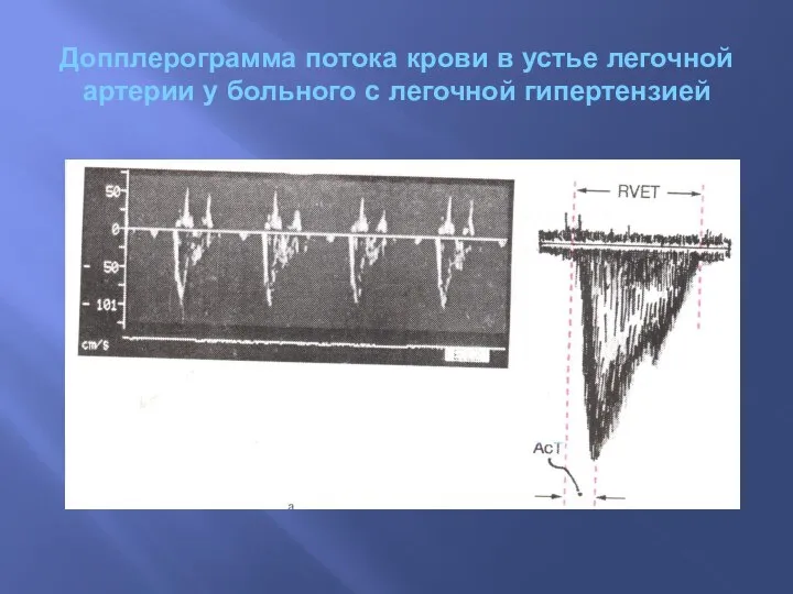 Допплерограмма потока крови в устье легочной артерии у больного с легочной гипертензией