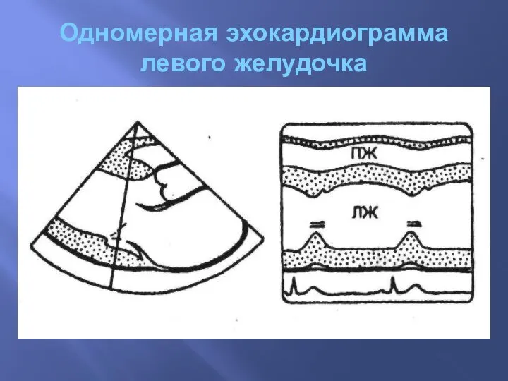 Одномерная эхокардиограмма левого желудочка