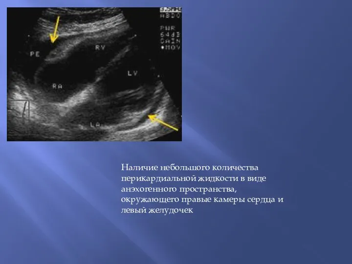 Наличие небольшого количества перикардиальной жидкости в виде анэхогенного пространства, окружающего правые камеры сердца и левый желудочек