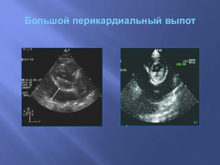 Большой перикардиальный выпот