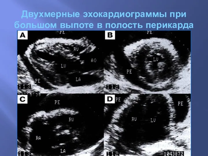 Двухмерные эхокардиограммы при большом выпоте в полость перикарда