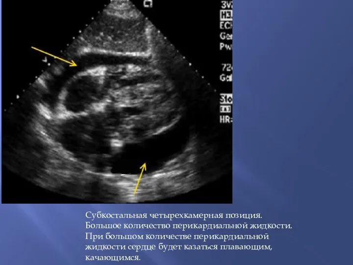 Субкостальная четырехкамерная позиция. Большое количество перикардиальной жидкости. При большом количестве перикардиальной жидкости