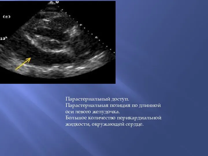 Парастернальный доступ. Парастернальная позиция по длинной оси левого желудочка. Большое количество перикардиальной жидкости, окружающей сердце.