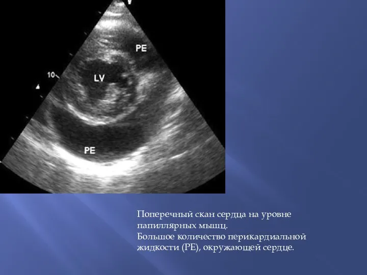 Поперечный скан сердца на уровне папиллярных мышц. Большое количество перикардиальной жидкости (РЕ), окружающей сердце.