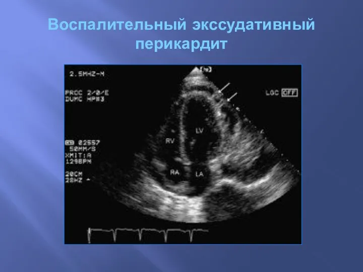 Воспалительный экссудативный перикардит