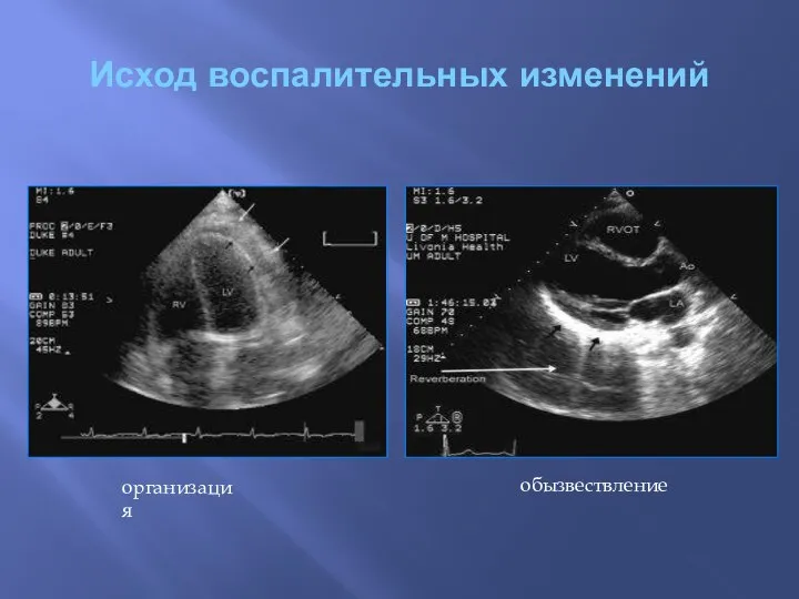 Исход воспалительных изменений организация обызвествление