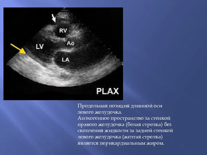 Продольная позиция длинной оси левого желудочка. Анэхогенное пространство за стенкой правого желудочка