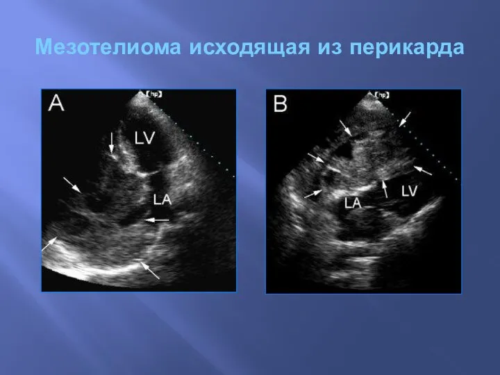 Мезотелиома исходящая из перикарда