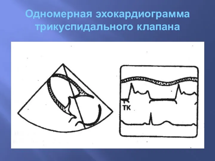 Одномерная эхокардиограмма трикуспидального клапана