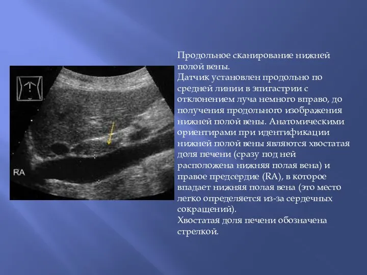 Продольное сканирование нижней полой вены. Датчик установлен продольно по средней линии в