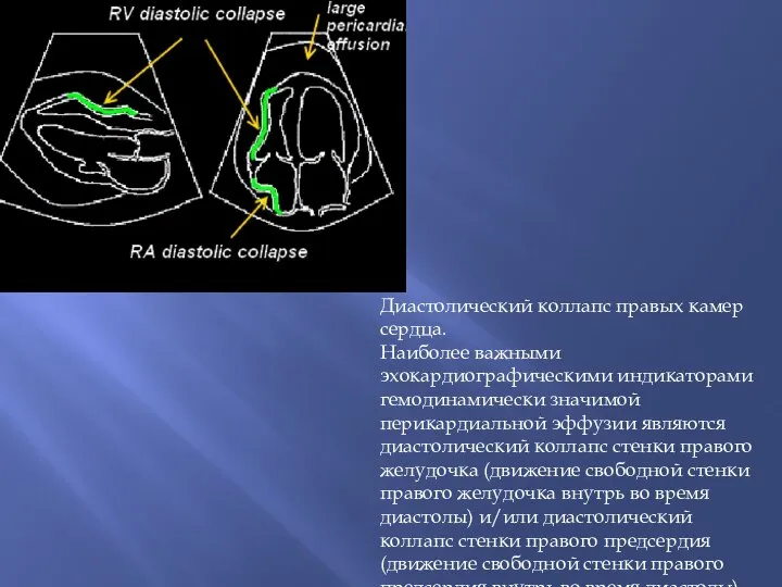 Диастолический коллапс правых камер сердца. Наиболее важными эхокардиографическими индикаторами гемодинамически значимой перикардиальной
