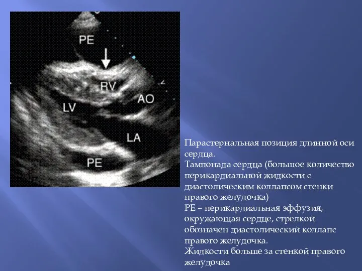 Парастернальная позиция длинной оси сердца. Тампонада сердца (большое количество перикардиальной жидкости с