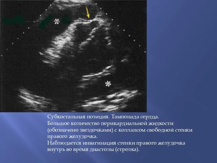 Субкостальная позиция. Тампонада сердца. Большое количество перикардиальной жидкости (обозначено звездочками) с коллапсом