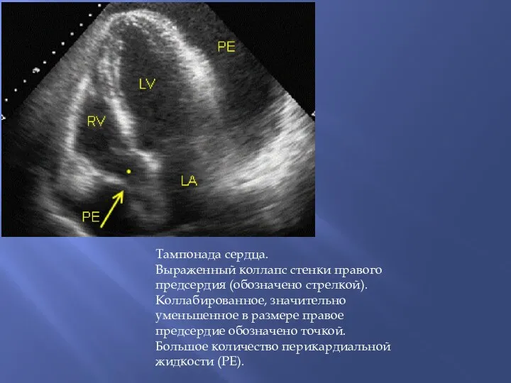 Тампонада сердца. Выраженный коллапс стенки правого предсердия (обозначено стрелкой). Коллабированное, значительно уменьшенное