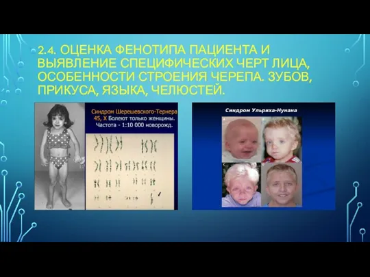 2.4. ОЦЕНКА ФЕНОТИПА ПАЦИЕНТА И ВЫЯВЛЕНИЕ СПЕЦИФИЧЕСКИХ ЧЕРТ ЛИЦА, ОСОБЕННОСТИ СТРОЕНИЯ ЧЕРЕПА. ЗУБОВ, ПРИКУСА, ЯЗЫКА, ЧЕЛЮСТЕЙ.