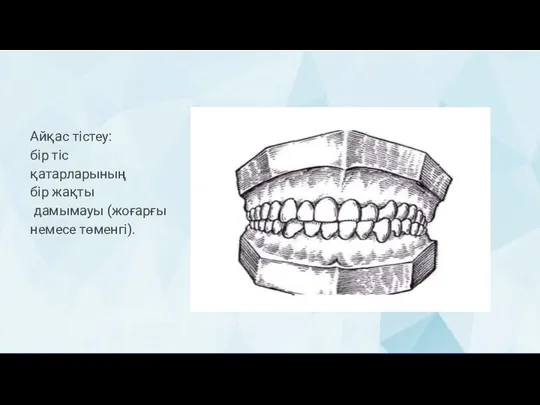 Айқас тістеу: бір тіс қатарларының бір жақты дамымауы (жоғарғы немесе төменгі).