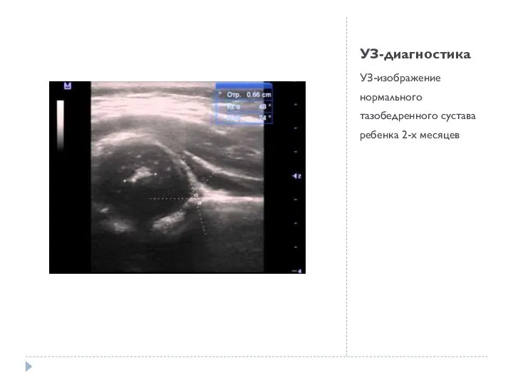 УЗ-диагностика УЗ-изображение нормального тазобедренного сустава ребенка 2-х месяцев
