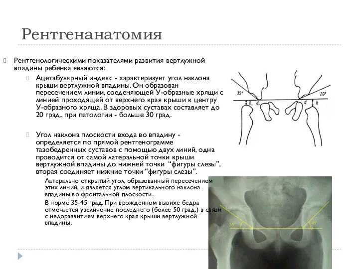 Рентгенанатомия Рентгенологическими показателями развития вертлужной впадины ребенка являются: Ацетабулярный индекс - характеризует