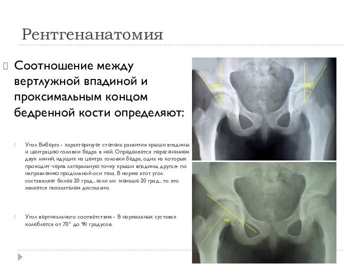 Рентгенанатомия Соотношение между вертлужной впадиной и проксимальным концом бедренной кости определяют: Угол