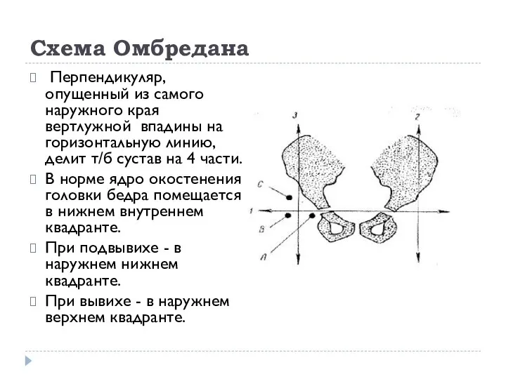 Схема Омбредана Перпендикуляр, опущенный из самого наружного края вертлужной впадины на горизонтальную