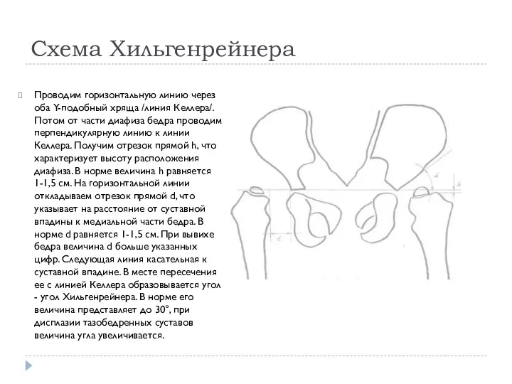 Схема Хильгенрейнера Проводим горизонтальную линию через оба Y-подобный хряща /линия Келлера/. Потом