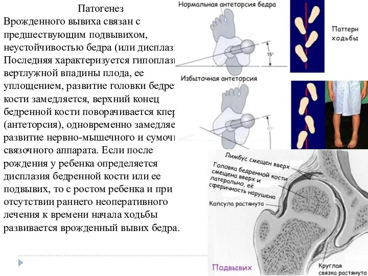 Патогенез Врожденного вывиха связан с предшествующим подвыви­хом, неустойчивостью бедра (или дисплазией). Последняя