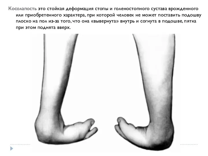 Косолапость это стойкая деформация стопы и голеностопного сустава врожденного или приобретенного характера,