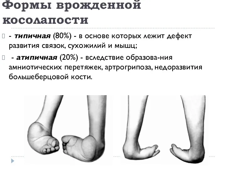 Формы врожденной косолапости - типичная (80%) - в основе которых лежит дефект