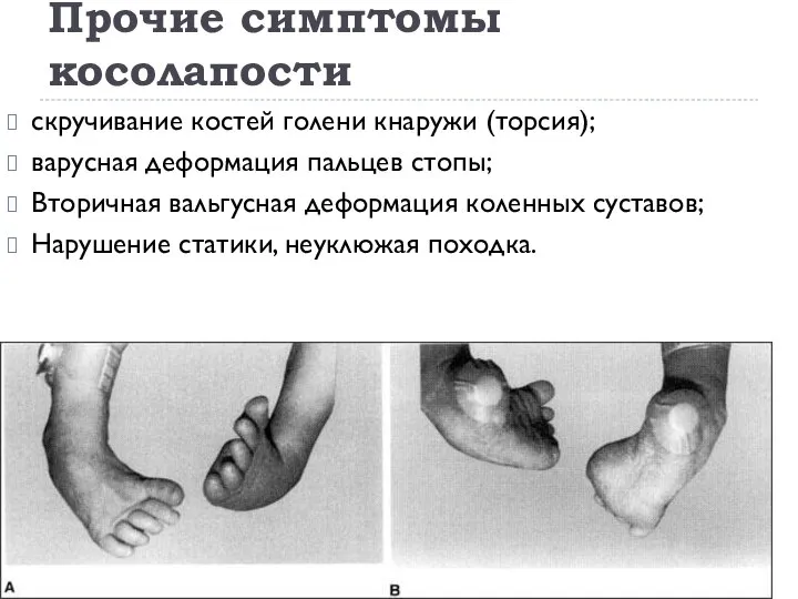 Прочие симптомы косолапости скручивание костей голени кнаружи (торсия); варусная деформация пальцев стопы;