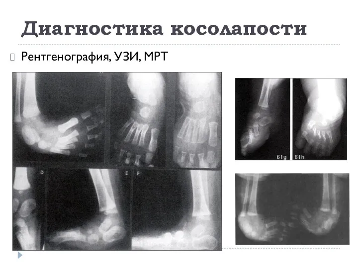 Диагностика косолапости Рентгенография, УЗИ, МРТ