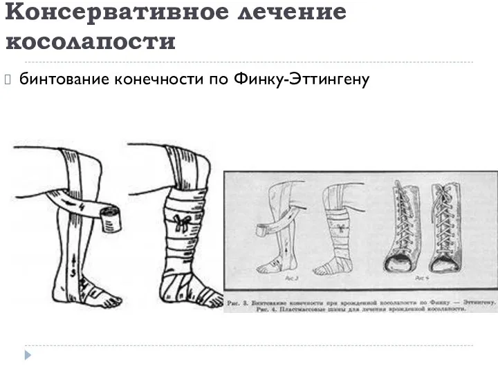 Консервативное лечение косолапости бинтование конечности по Финку-Эттингену