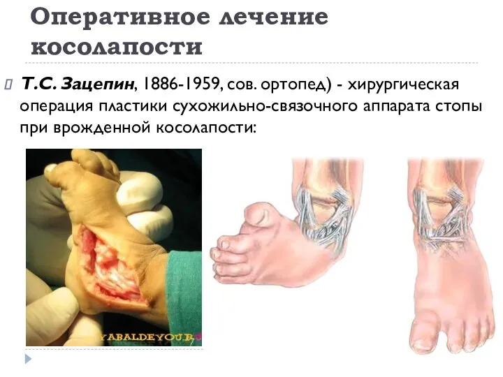 Оперативное лечение косолапости Т.С. Зацепин, 1886-1959, сов. ортопед) - хирургическая операция пластики