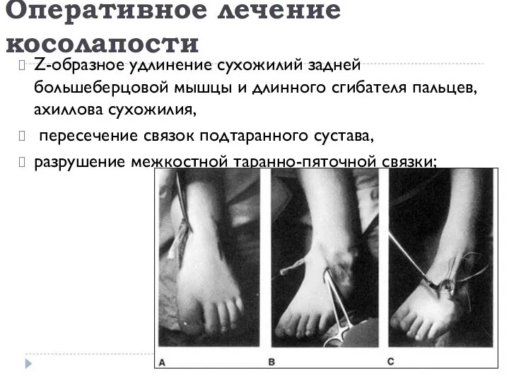 Оперативное лечение косолапости Z-образное удлинение сухожилий задней большеберцовой мышцы и длинного сгибателя